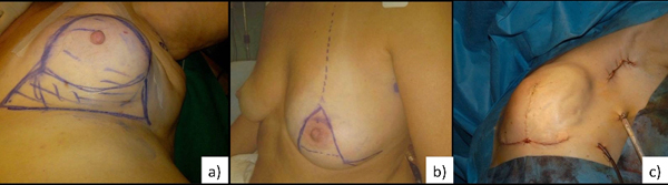 Breast Reduction Inferior Dermal Pedicle Technique: Modified